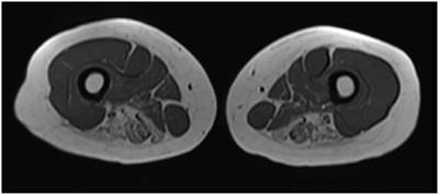 Case Report: Calpainopathy Presenting After Bone Marrow Transplantation, With Studies of Donor Genetic Content in Various Tissue Types